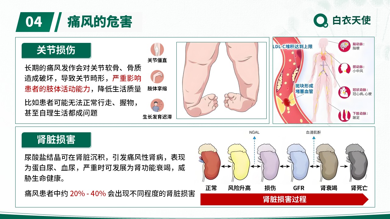 17-警惕痛风健康宣教第6页预览