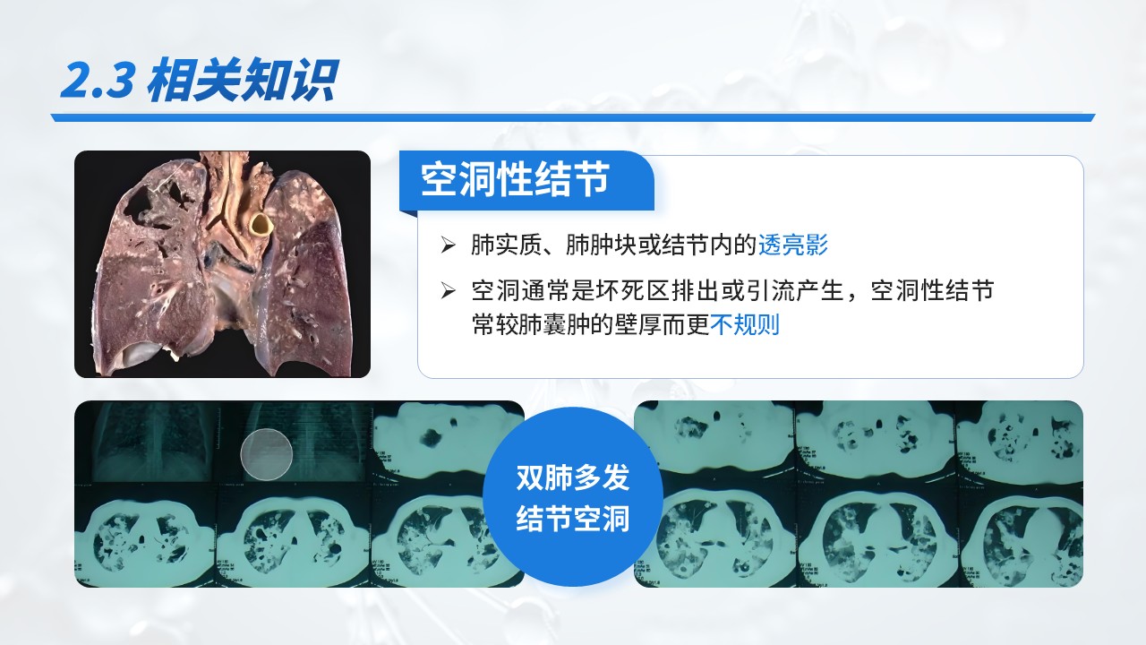 23-重症肺炎耶氏孢子菌肺炎病例介绍第11页预览