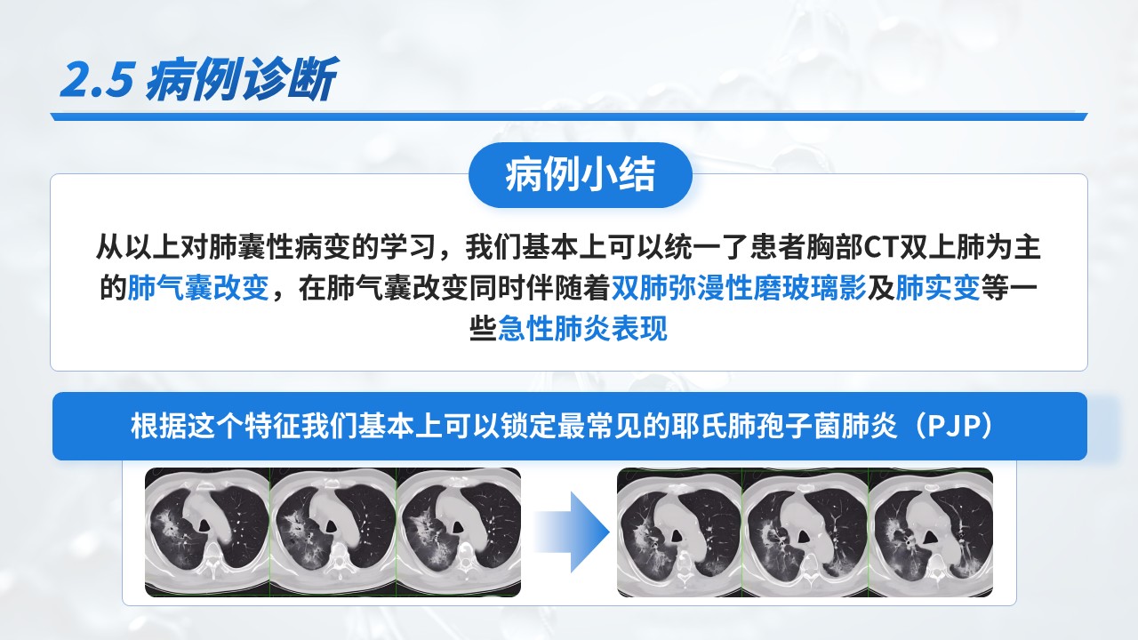 23-重症肺炎耶氏孢子菌肺炎病例介绍第13页预览