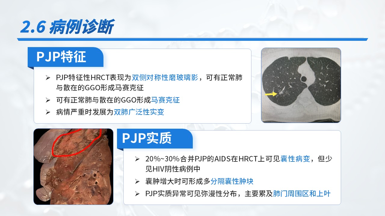 23-重症肺炎耶氏孢子菌肺炎病例介绍第14页预览