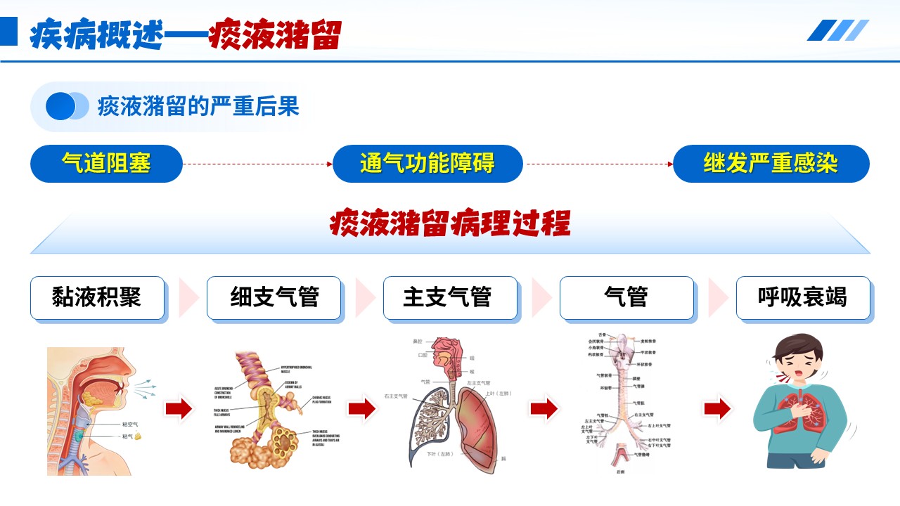 523期-护理说课-叩背排痰技术的规范操作第9页预览
