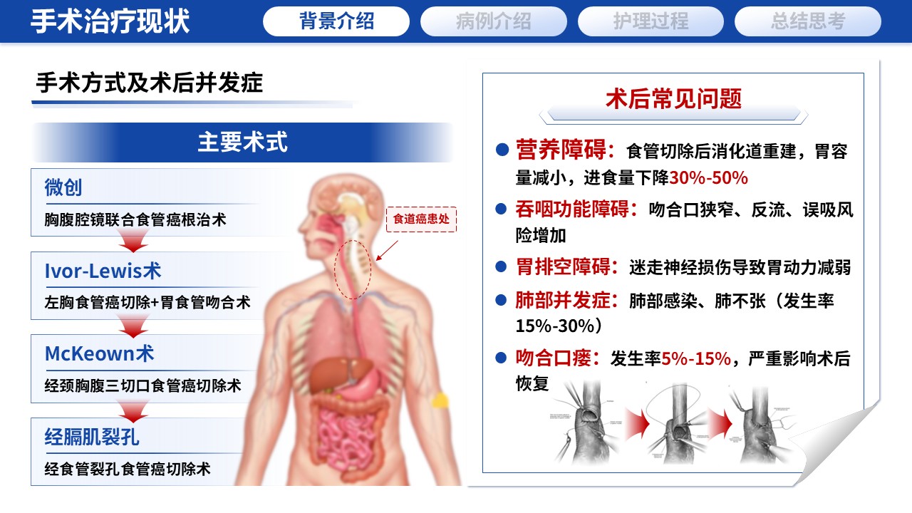 389期-护理个案-一例食管癌术后营养管理与吞咽功能康复的延续性护理个案第4页预览