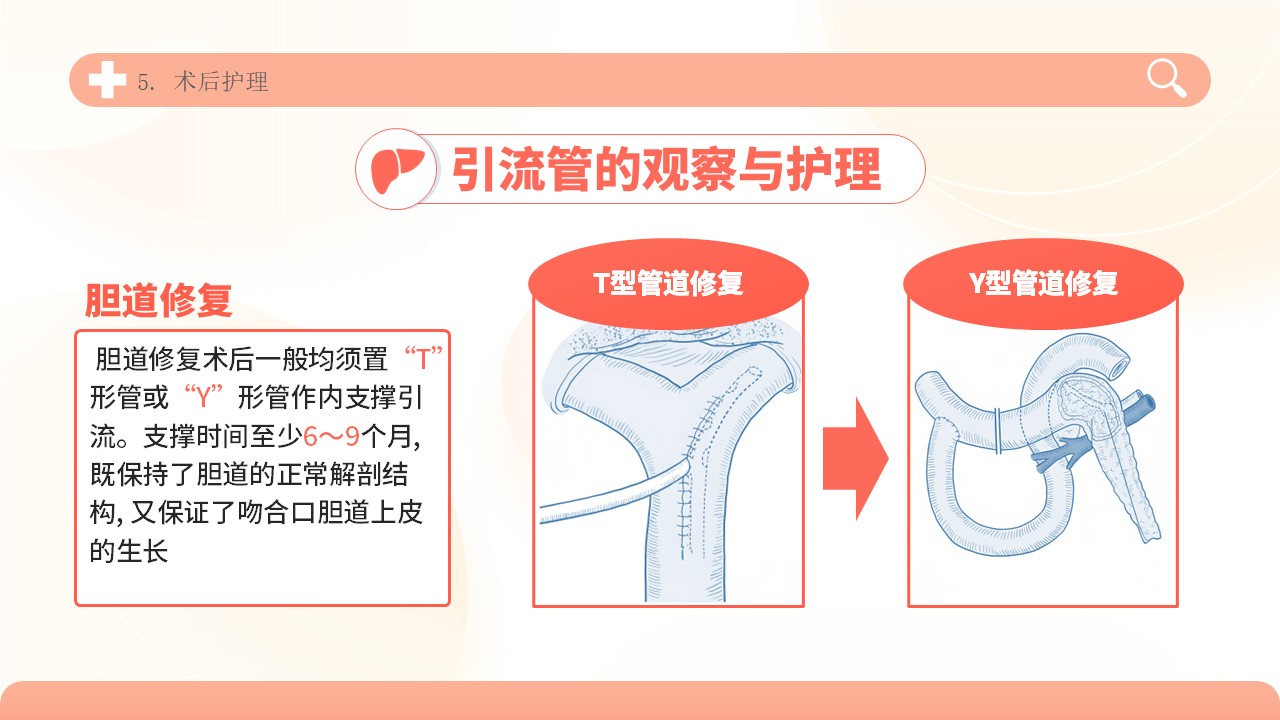 04-胆道损伤护理方案第24页预览
