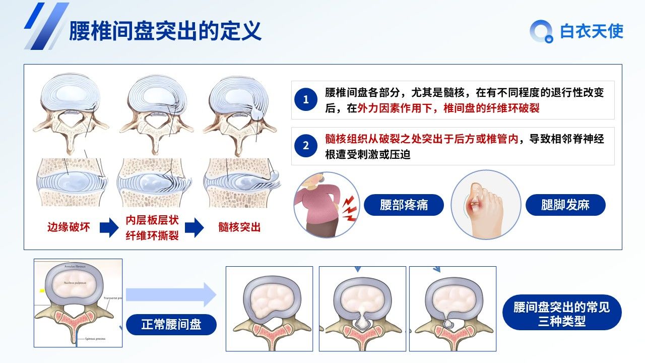 25-腰间盘突出健康宣教第5页预览
