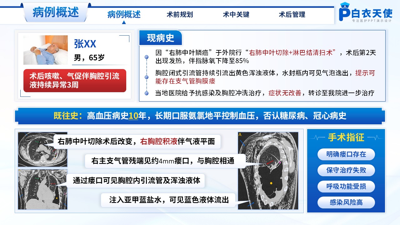 213期-医生个案-一例气管胸膜瘘镜下主气管支架植入术第3页预览
