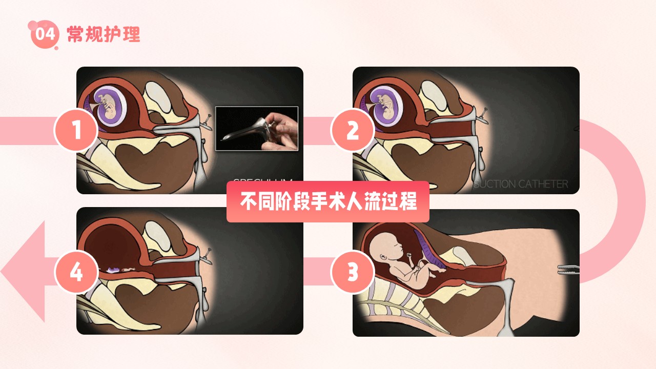 19-子宫内膜护理第22页预览