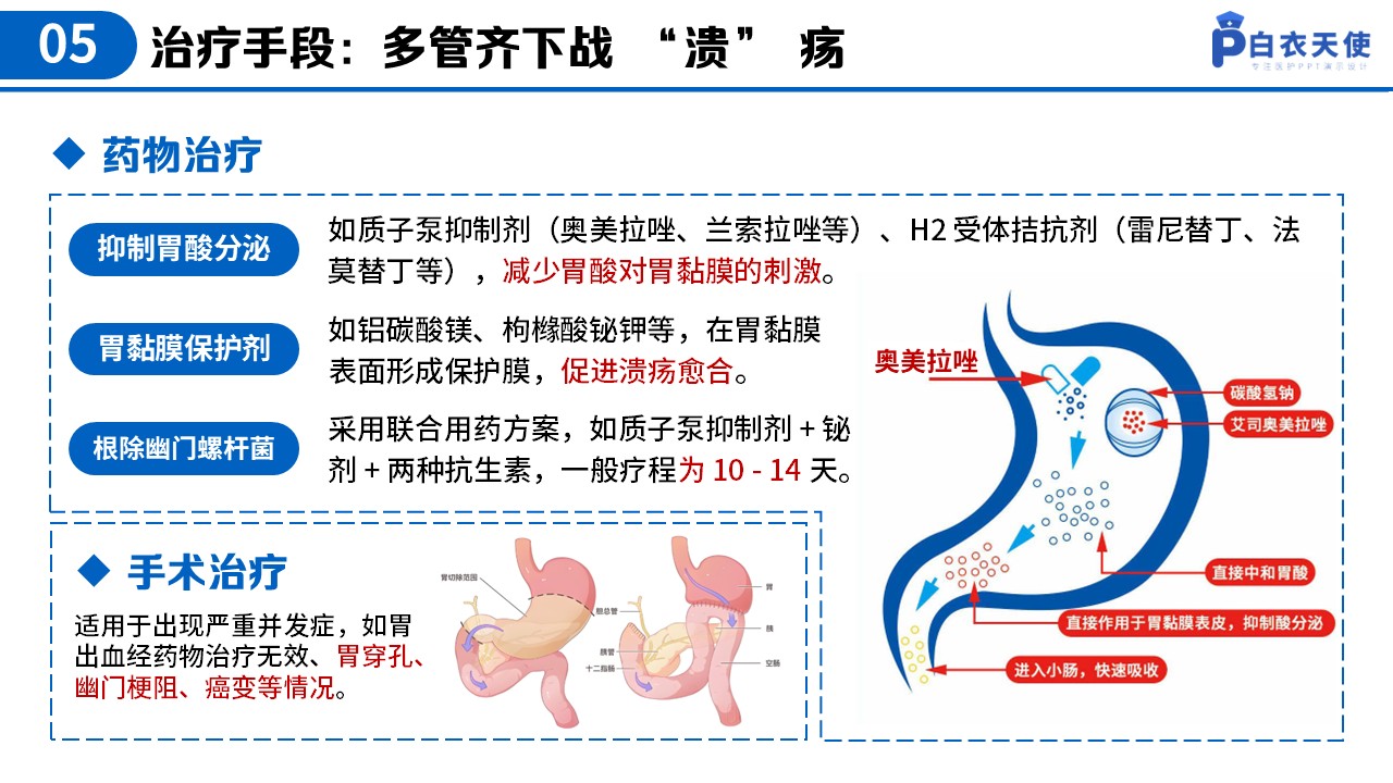 37-胃溃疡健康宣教第8页预览