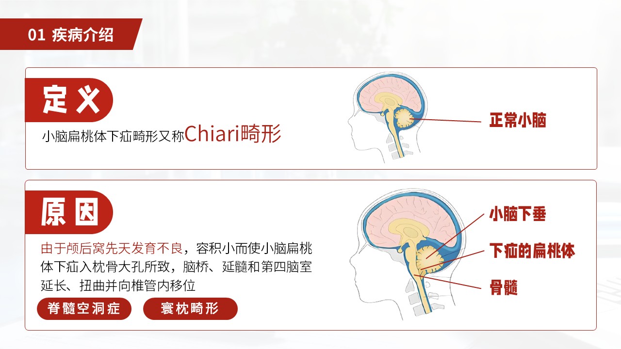 27-小脑扁桃体下疝畸形护理常规第4页预览