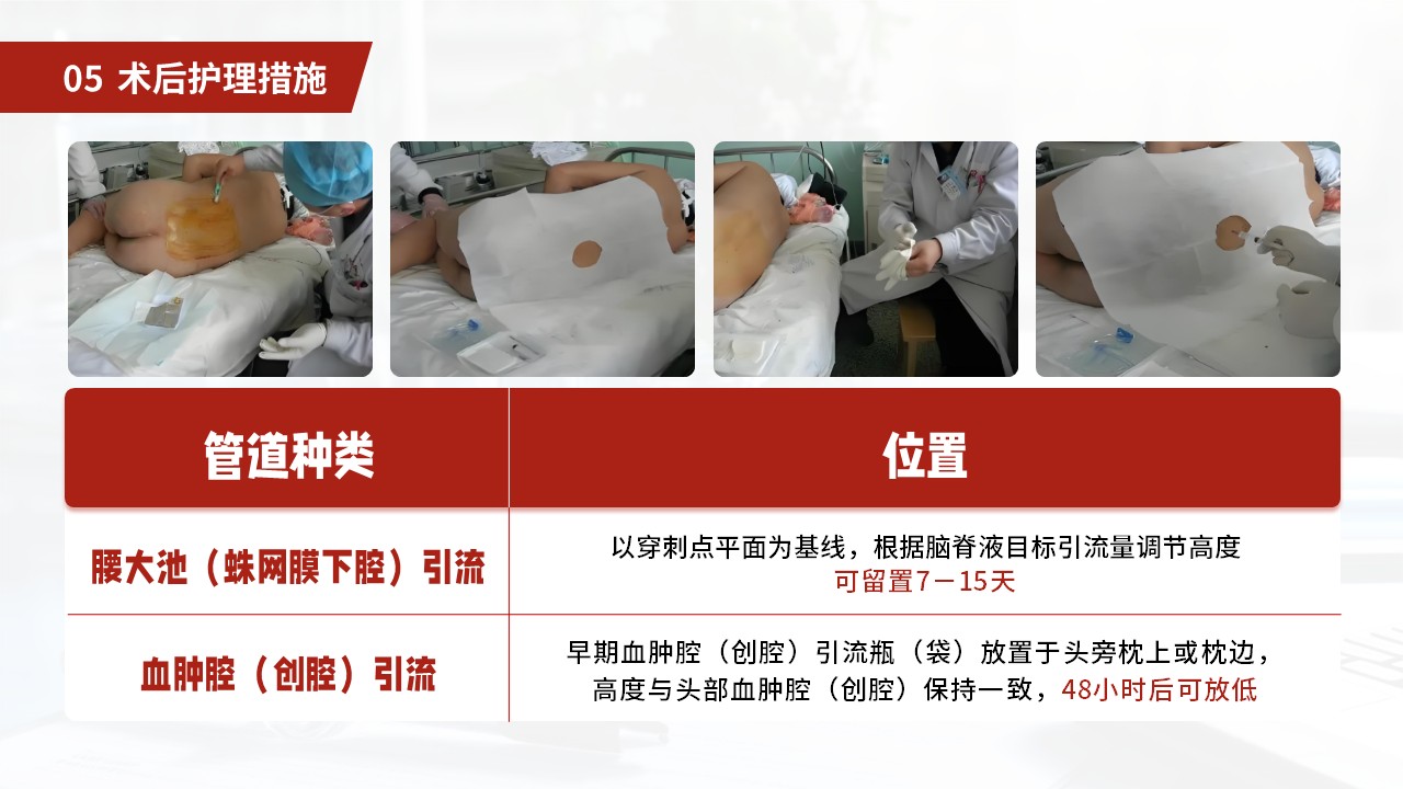 27-小脑扁桃体下疝畸形护理常规第28页预览
