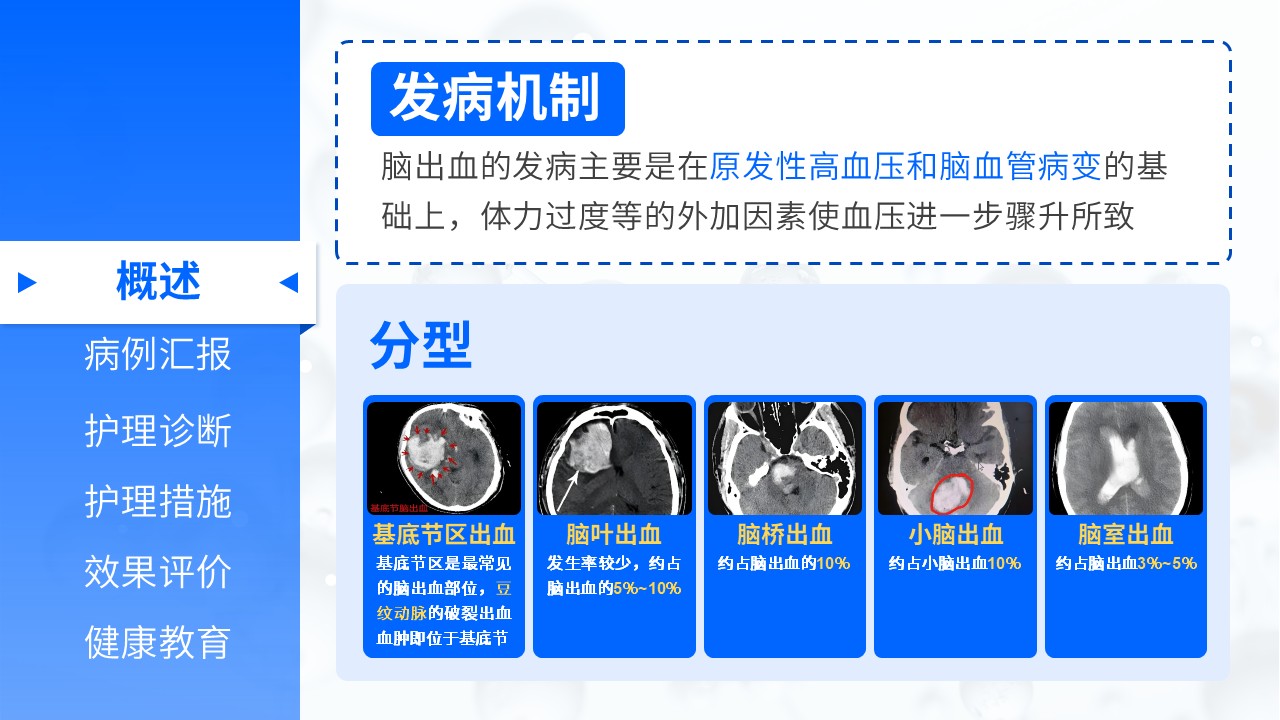 08-脑出血病人的护理查房第3页预览