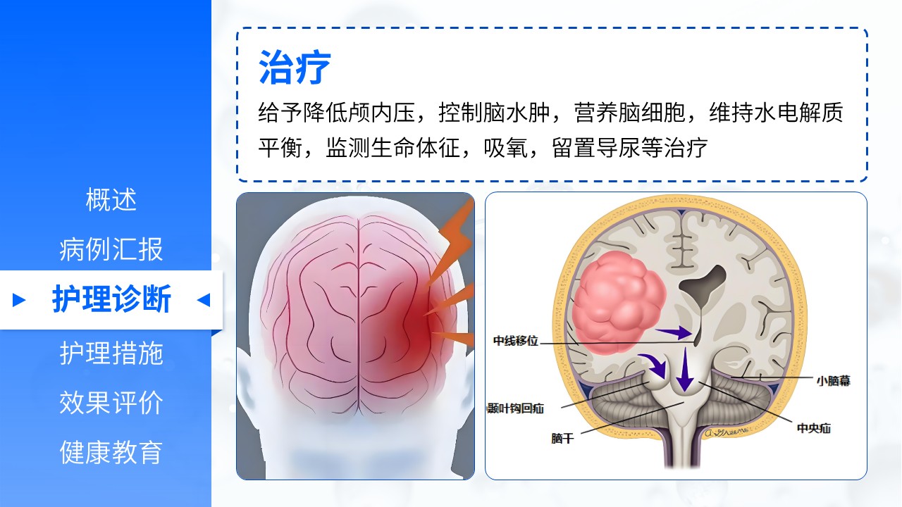 08-脑出血病人的护理查房第7页预览