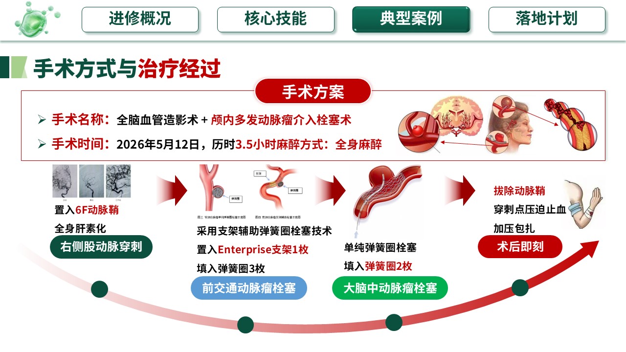 360期-护士进修汇报-预见性护理在多动脉瘤栓塞术后的应用第12页预览