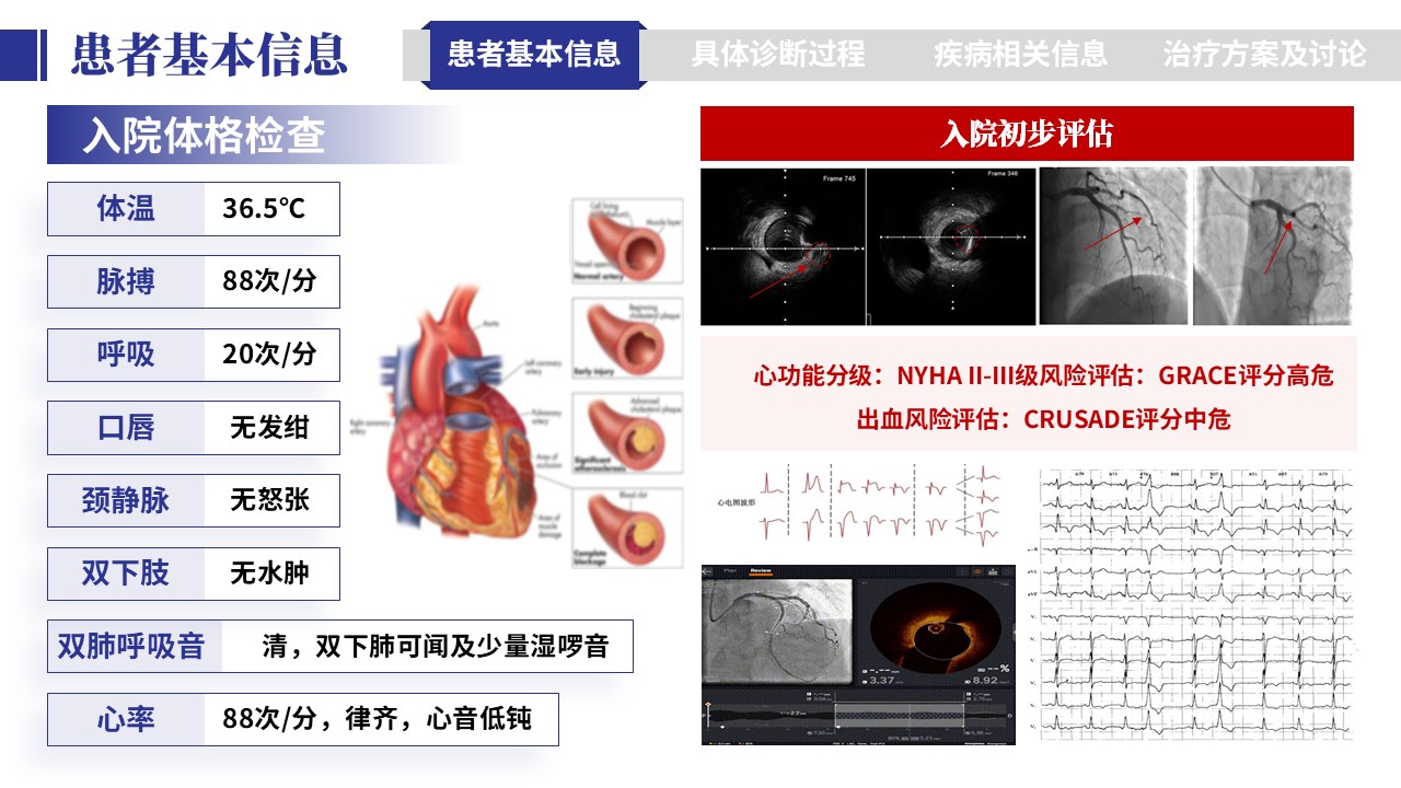 401期-病例汇报-一例多支冠脉病变一站式介入治疗病例汇报第4页预览