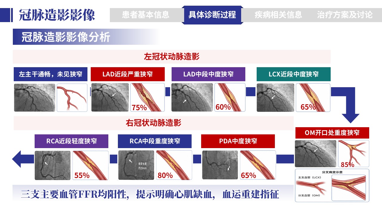 401期-病例汇报-一例多支冠脉病变一站式介入治疗病例汇报第8页预览