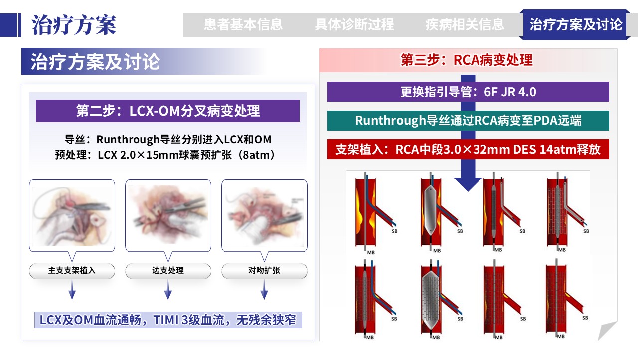 401期-病例汇报-一例多支冠脉病变一站式介入治疗病例汇报第16页预览
