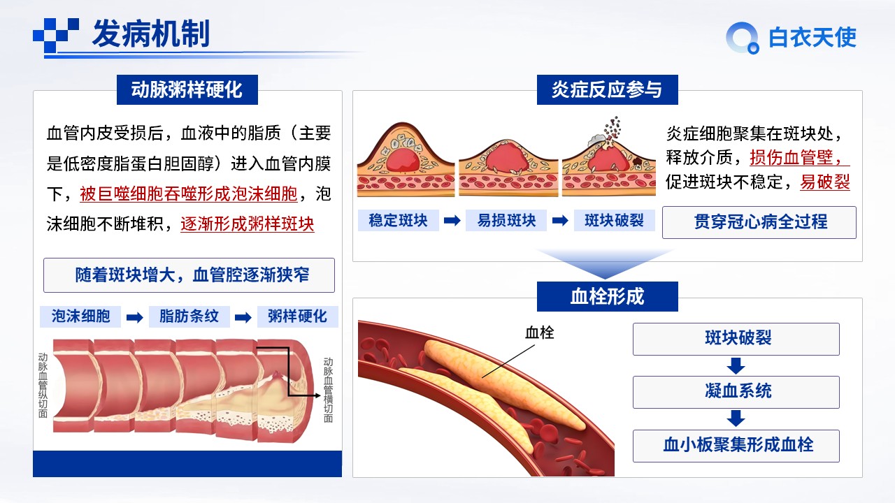 09-冠心病健康宣教第5页预览