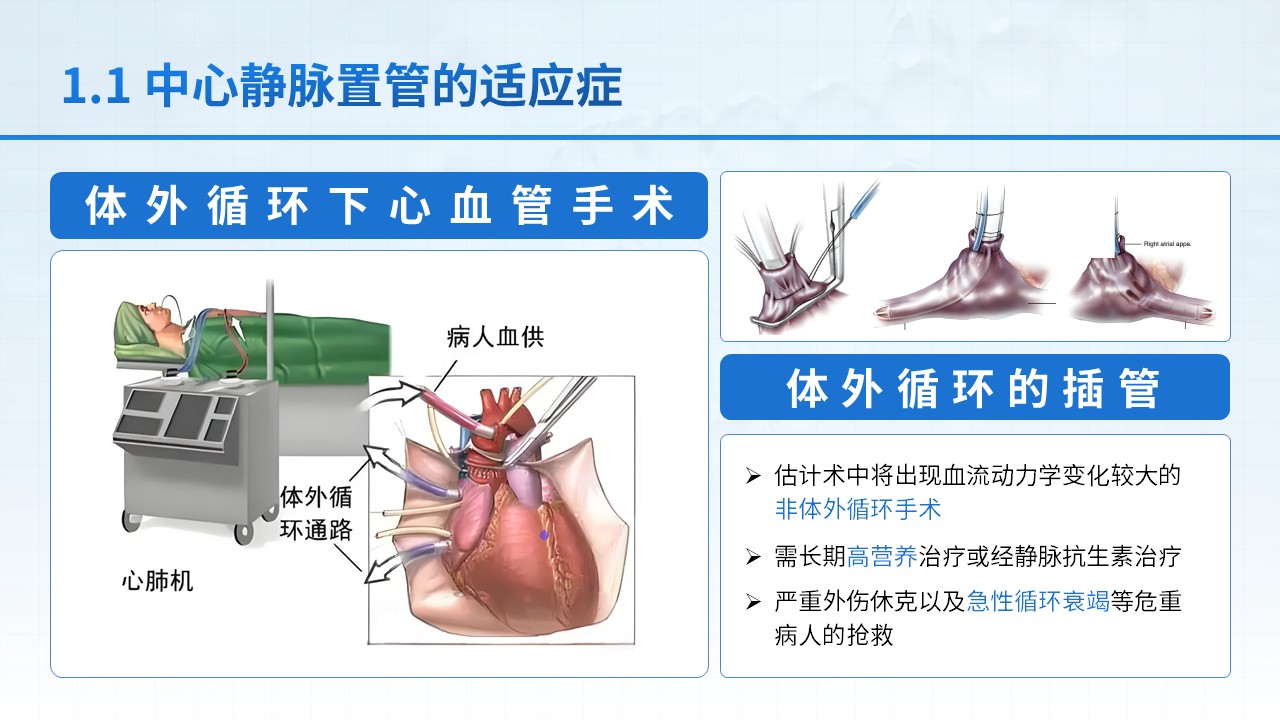 25-中心静脉置管护理第4页预览
