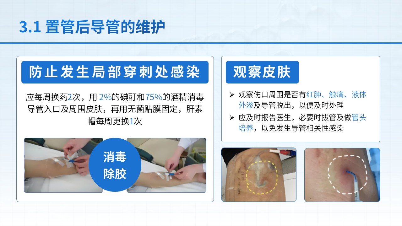25-中心静脉置管护理第11页预览
