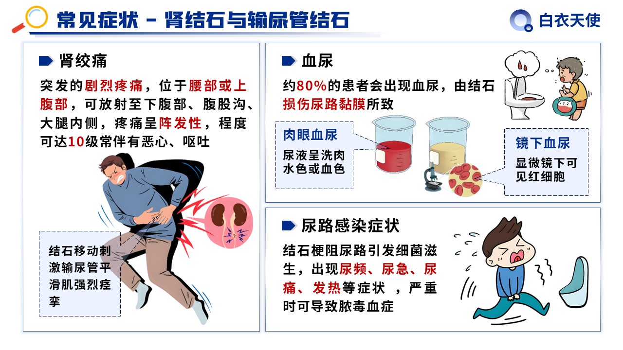 31-泌尿道结石健康宣教第7页预览