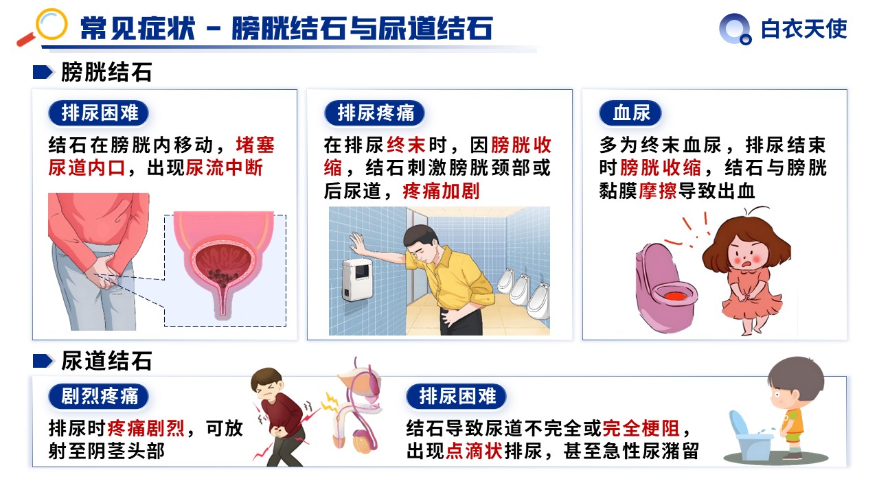 31-泌尿道结石健康宣教第8页预览