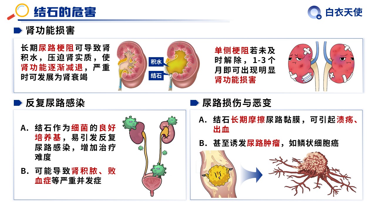 31-泌尿道结石健康宣教第9页预览