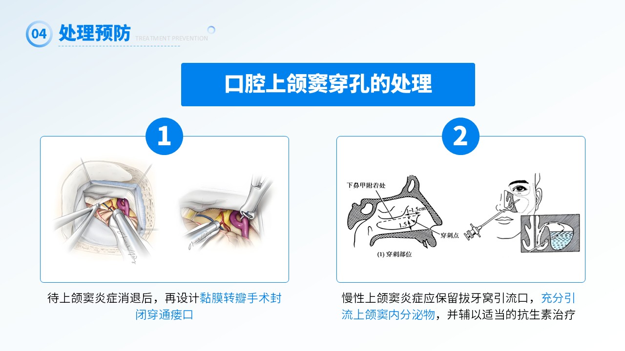 26-上颌窦瘘修补术第17页预览
