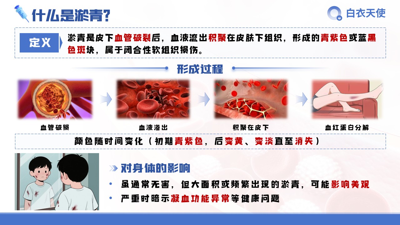 28-扎针后淤青健康宣教第3页预览