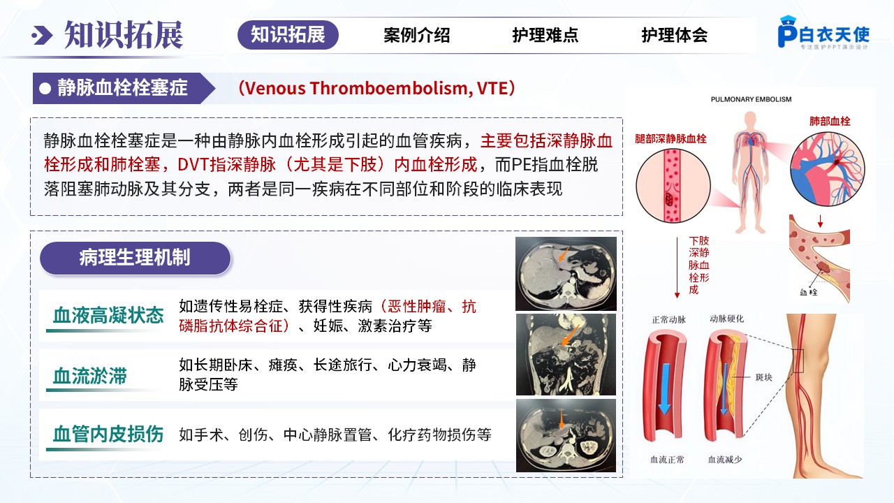 262期-疑难病例-一例静脉血栓栓塞症患者的疑难病例讨论第3页预览