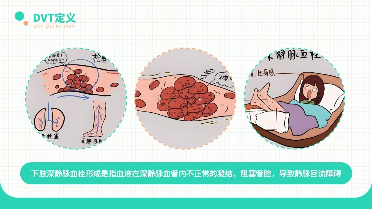 20-长期卧床患者下肢深静脉血栓的评估及预防策略第5页预览