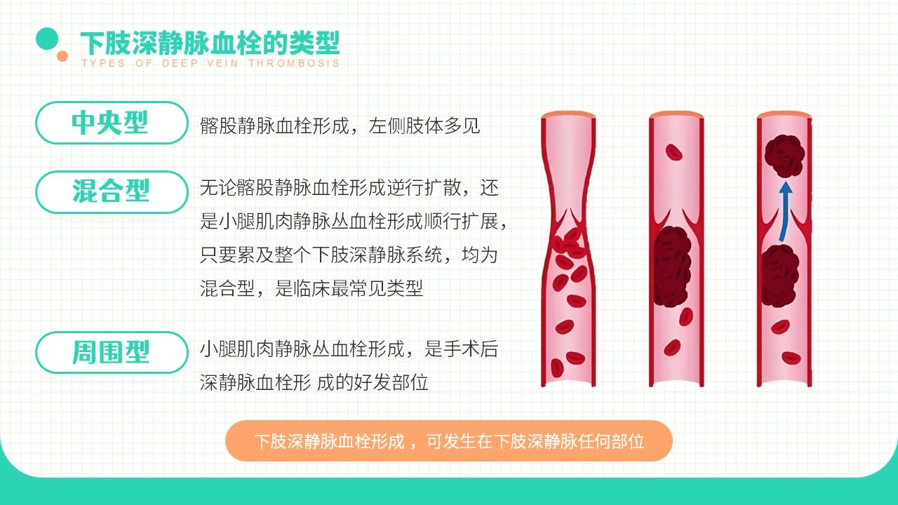 20-长期卧床患者下肢深静脉血栓的评估及预防策略第7页预览